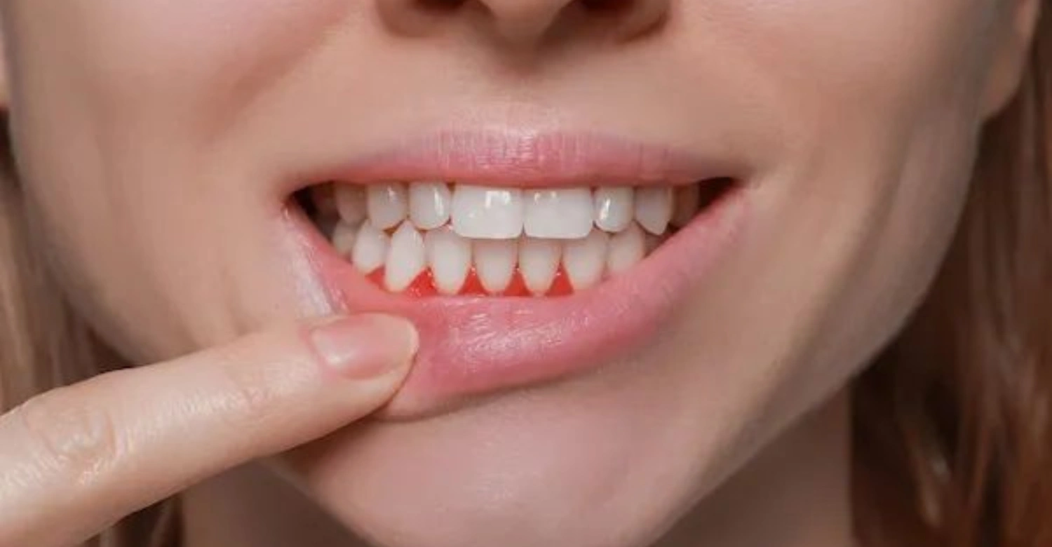 Hypogammaglobulinemia and Gum Disease1